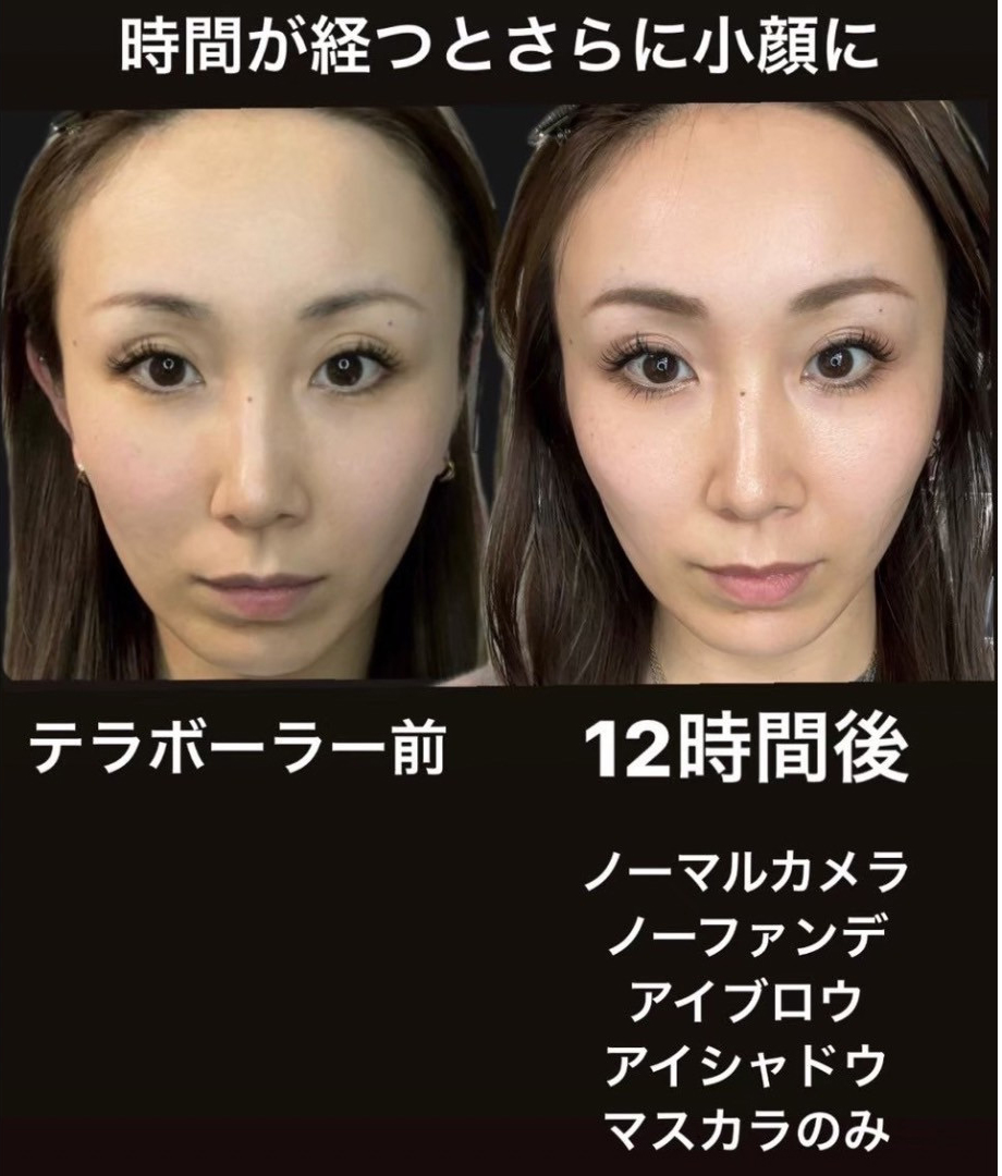 テラボーラーの効果